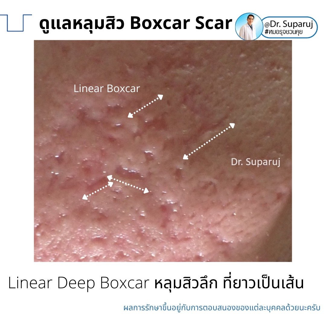 เทคนิคดูแลหลุมสิวลึกขอบชัด Deep Boxcar Scar !!