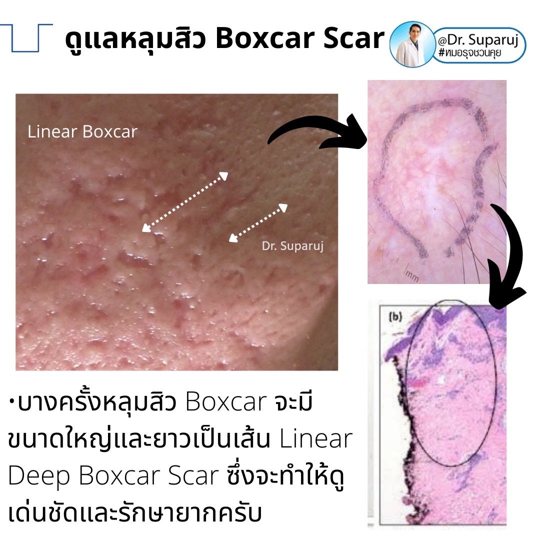 เทคนิคดูแลหลุมสิวลึกขอบชัด Deep Boxcar Scar !! เทคนิคดูแลหลุมสิวลึกขอบชัด Deep Boxcar Scar !!