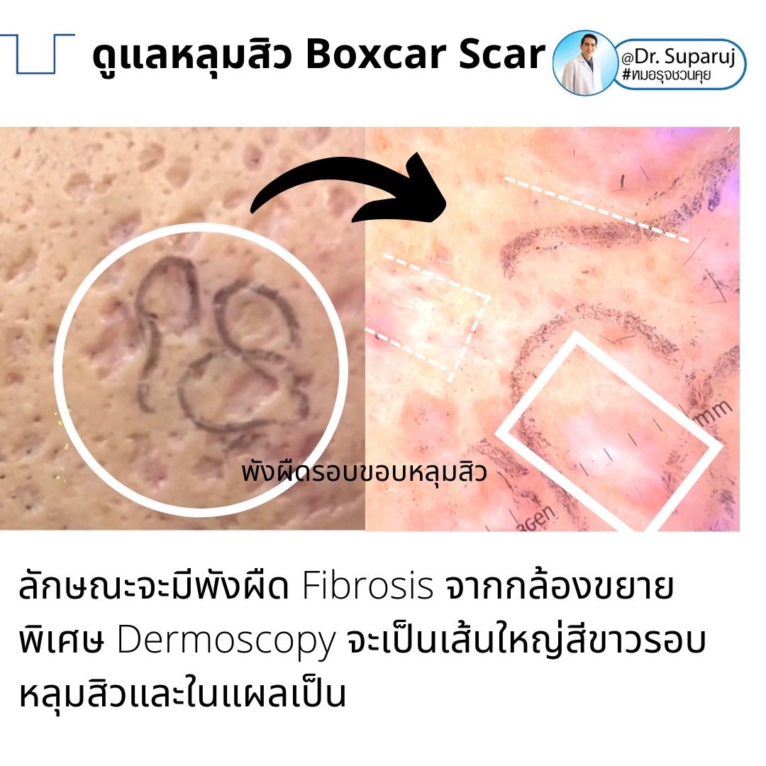 เทคนิคดูแลหลุมสิวลึกขอบชัด Deep Boxcar Scar !! เทคนิคดูแลหลุมสิวลึกขอบชัด Deep Boxcar Scar !!