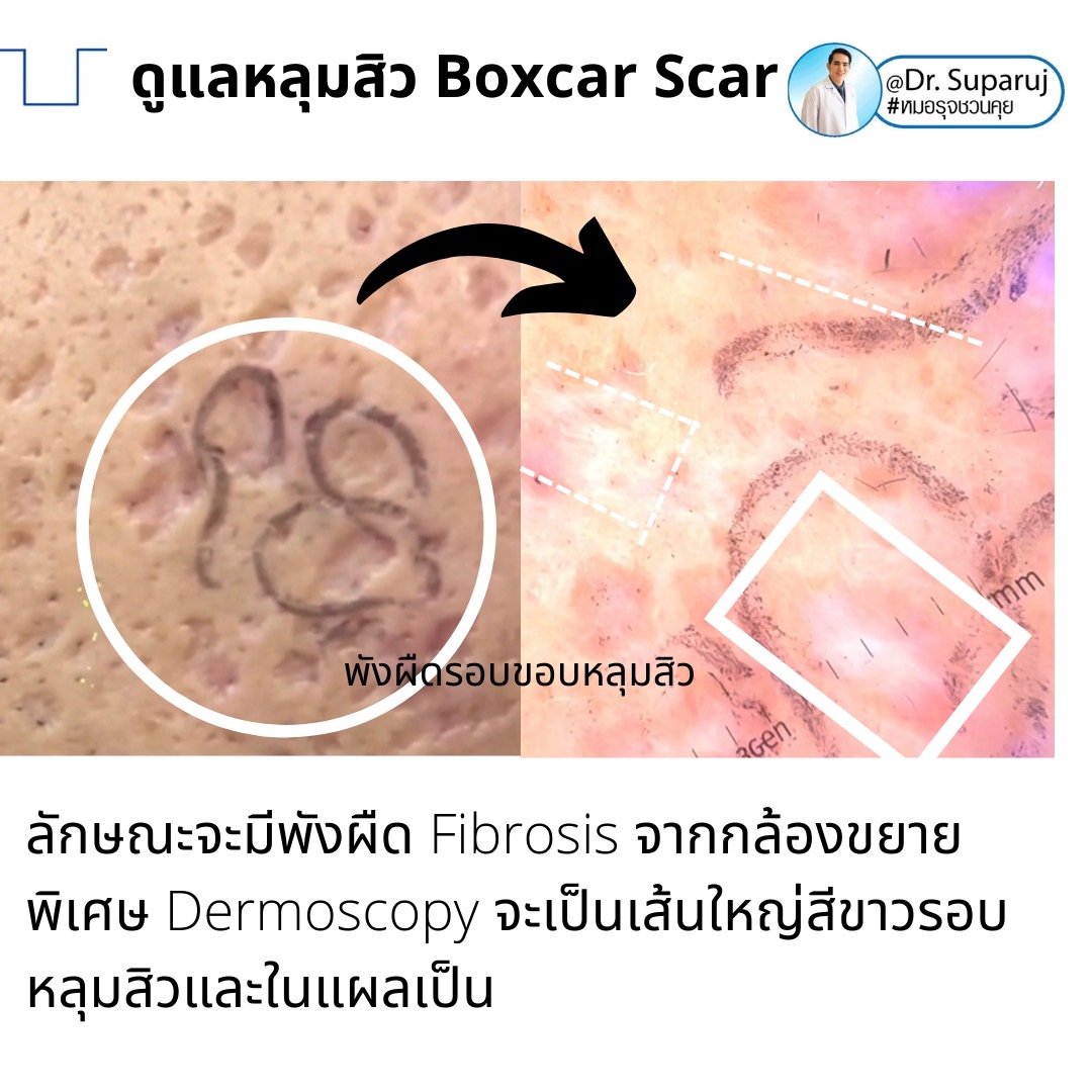 เทคนิคดูแลหลุมสิวลึกขอบชัด Deep Boxcar Scar !!