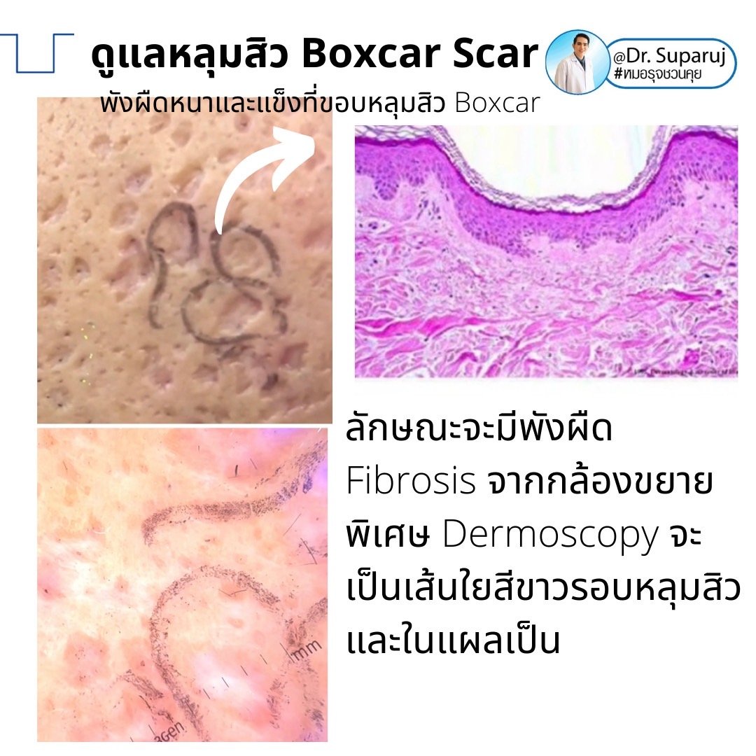 เทคนิคดูแลหลุมสิวลึกขอบชัด Deep Boxcar Scar !! เทคนิคดูแลหลุมสิวลึกขอบชัด Deep Boxcar Scar !!