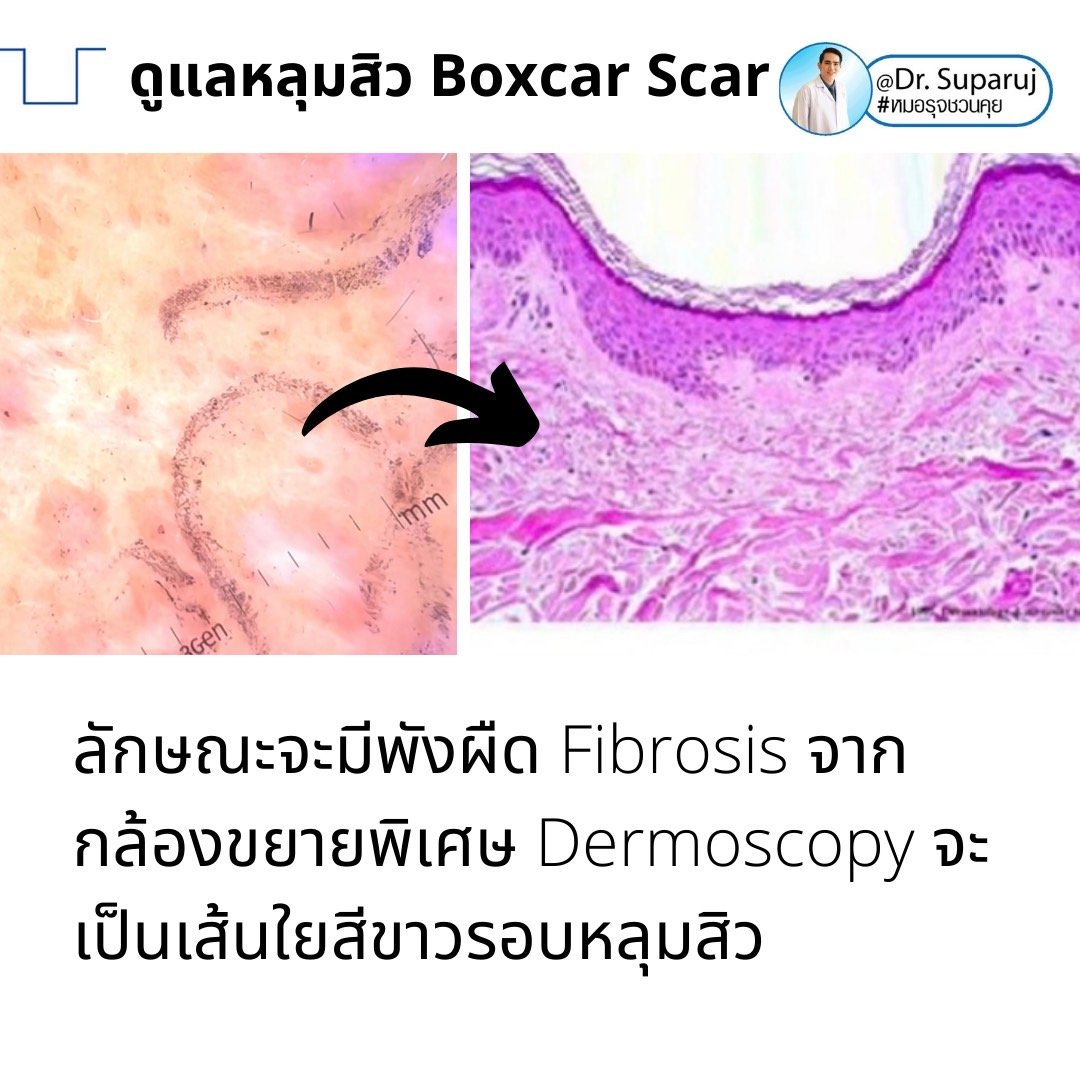 เทคนิคดูแลหลุมสิวลึกขอบชัด Deep Boxcar Scar !!