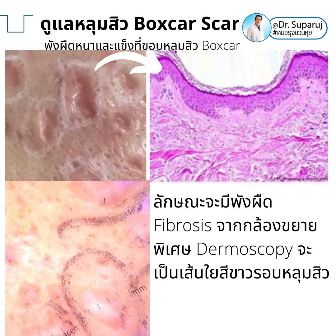 เทคนิคดูแลหลุมสิวลึกขอบชัด Deep Boxcar Scar !!