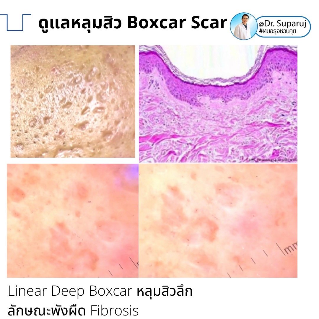 เทคนิคดูแลหลุมสิวลึกขอบชัด Deep Boxcar Scar !!