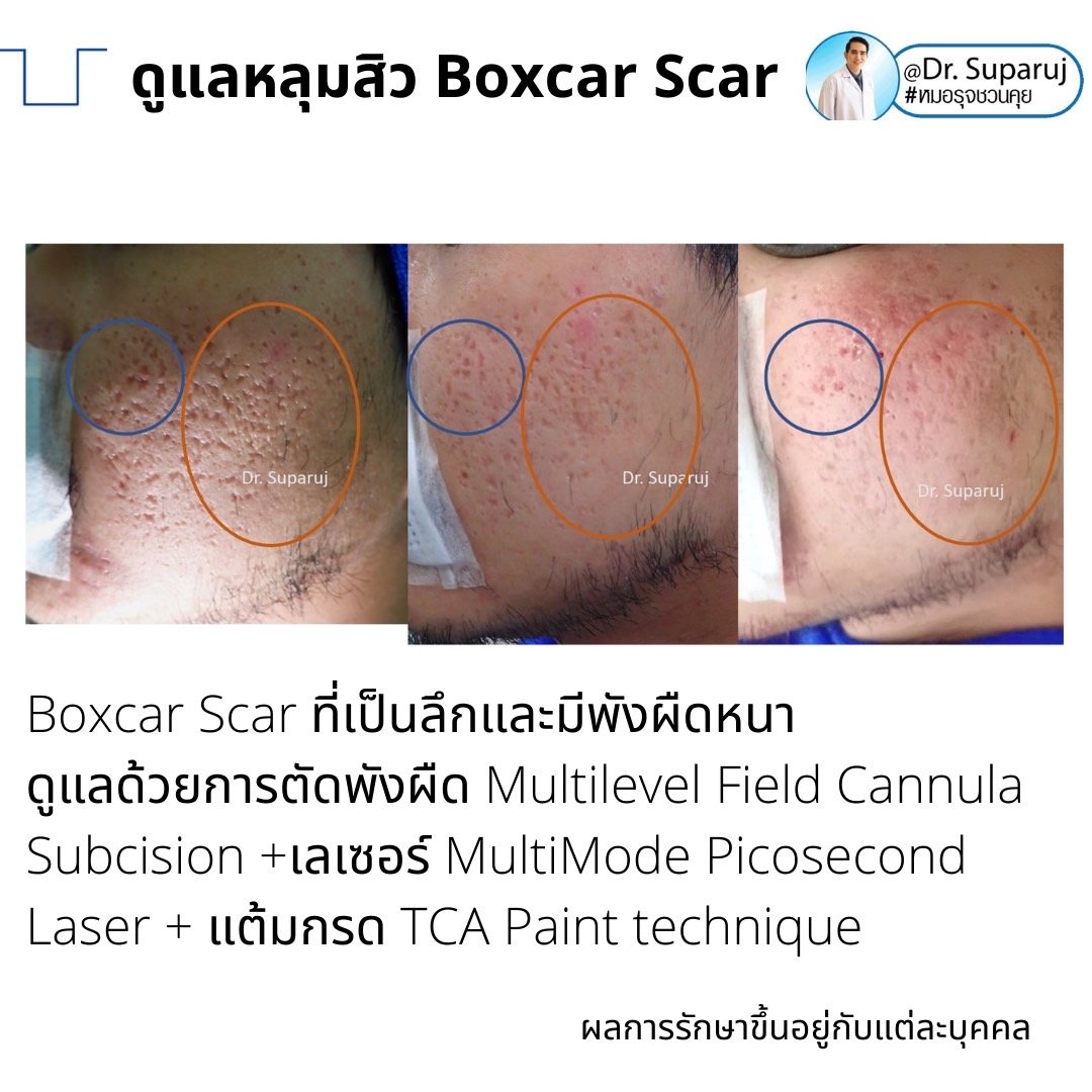 เทคนิคดูแลหลุมสิวลึกขอบชัด Deep Boxcar Scar !! เทคนิคดูแลหลุมสิวลึกขอบชัด Deep Boxcar Scar !!