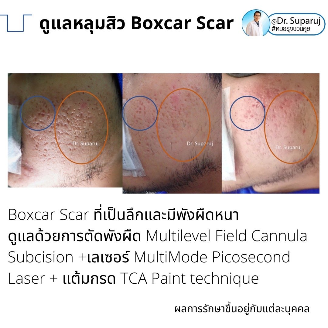 เทคนิคดูแลหลุมสิวลึกขอบชัด Deep Boxcar Scar !!