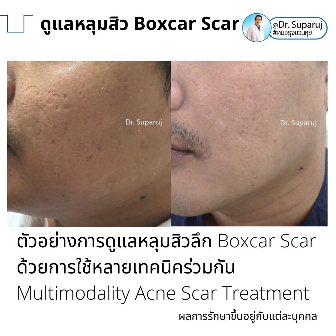 เทคนิคดูแลหลุมสิวลึกขอบชัด Deep Boxcar Scar !! เทคนิคดูแลหลุมสิวลึกขอบชัด Deep Boxcar Scar !!