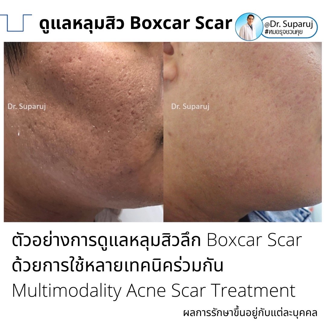 เทคนิคดูแลหลุมสิวลึกขอบชัด Deep Boxcar Scar !! เทคนิคดูแลหลุมสิวลึกขอบชัด Deep Boxcar Scar !!