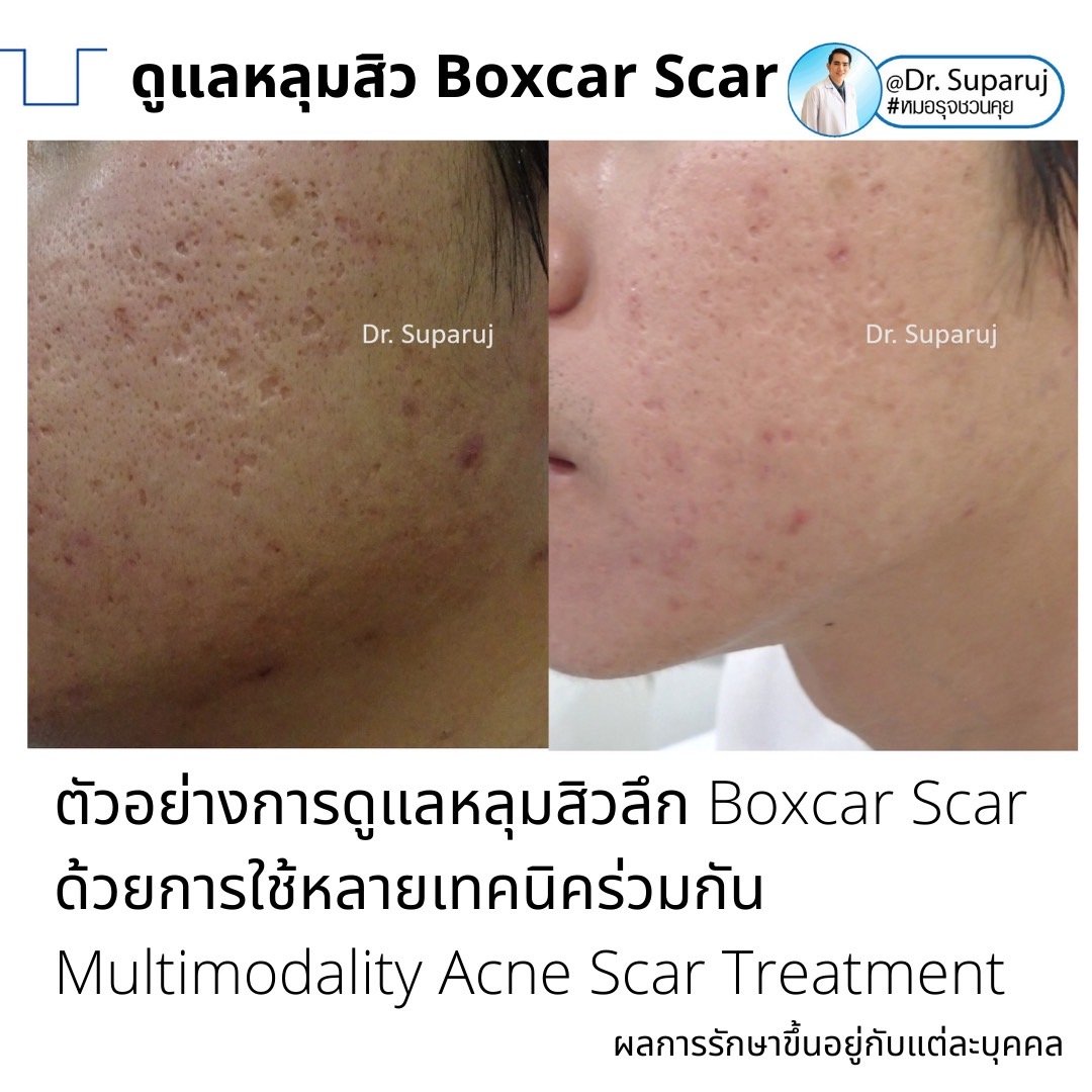 เทคนิคดูแลหลุมสิวลึกขอบชัด Deep Boxcar Scar !!