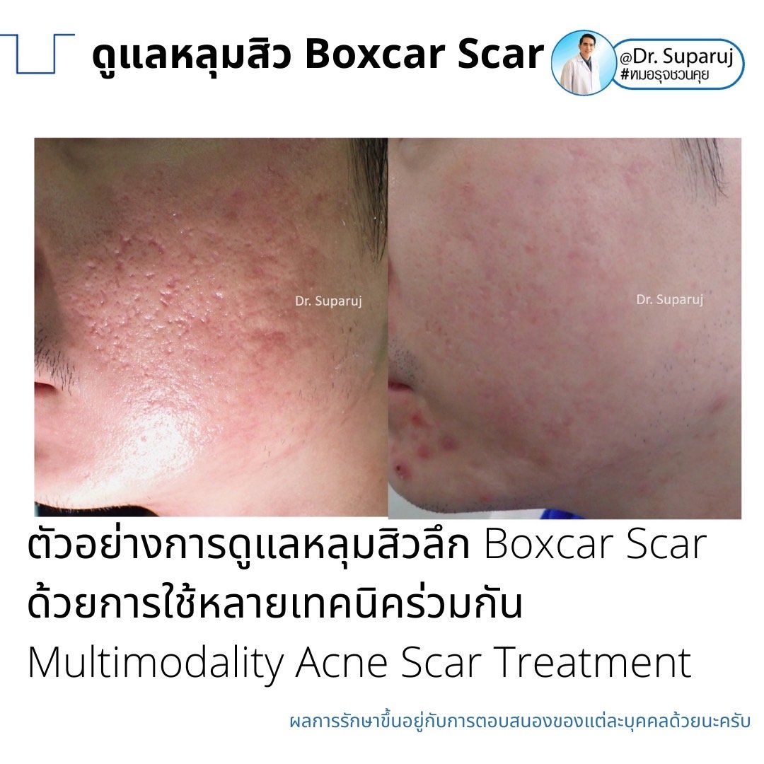 เทคนิคดูแลหลุมสิวลึกขอบชัด Deep Boxcar Scar !! เทคนิคดูแลหลุมสิวลึกขอบชัด Deep Boxcar Scar !!