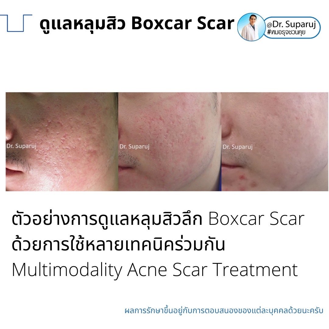 เทคนิคดูแลหลุมสิวลึกขอบชัด Deep Boxcar Scar !! เทคนิคดูแลหลุมสิวลึกขอบชัด Deep Boxcar Scar !!