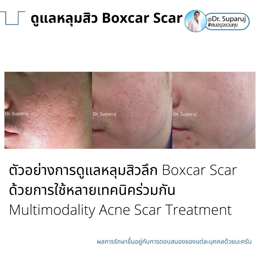 เทคนิคดูแลหลุมสิวลึกขอบชัด Deep Boxcar Scar !!