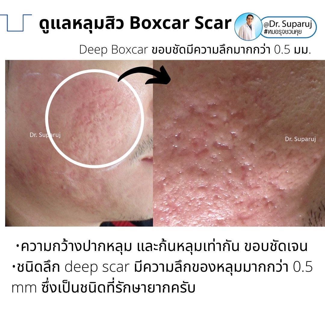 เทคนิคดูแลหลุมสิวลึกขอบชัด Deep Boxcar Scar !!