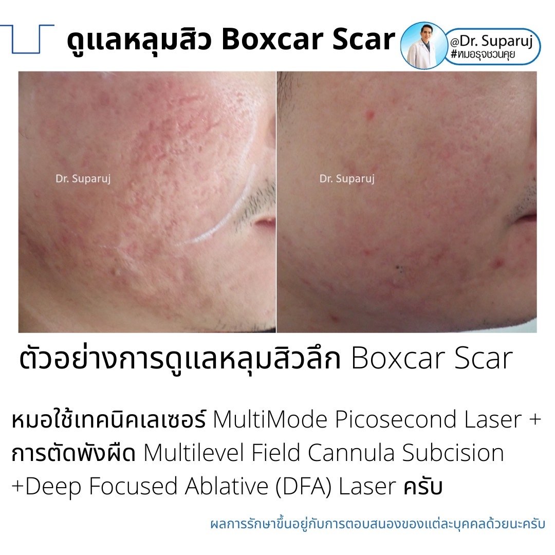 เทคนิคดูแลหลุมสิวลึกขอบชัด Deep Boxcar Scar !!