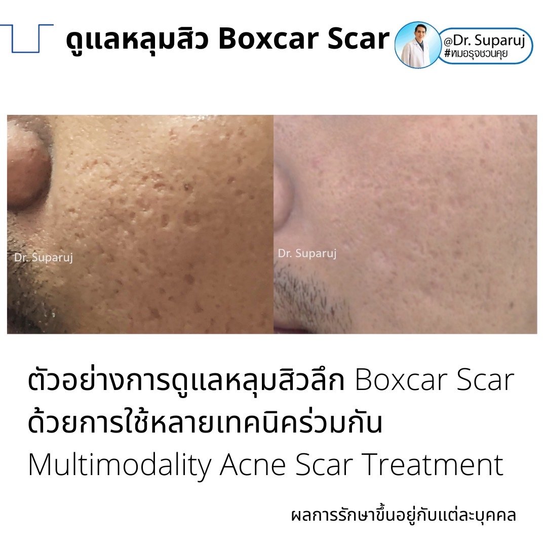 เทคนิคดูแลหลุมสิวลึกขอบชัด Deep Boxcar Scar !!