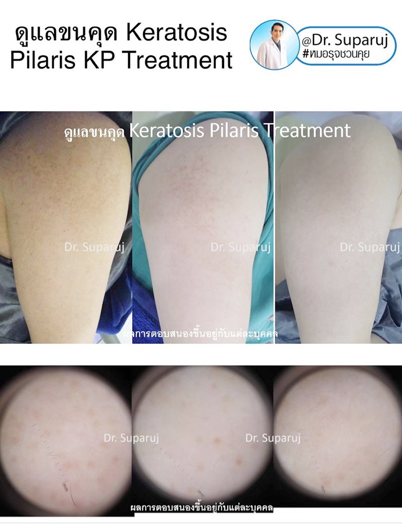 คำแนะนำในการดูแลผิวสำหรับผู้ที่มีปัญหาขนคุด KP Keratosis Pilaris คำแนะนำในการดูแลผิวสำหรับผู้ที่มีปัญหาขนคุด KP Keratosis Pilaris