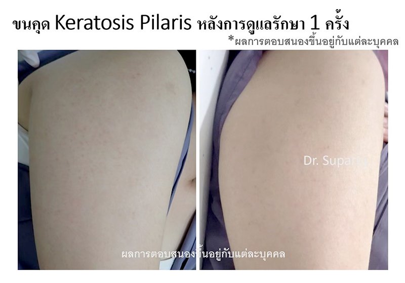 คำแนะนำในการดูแลผิวสำหรับผู้ที่มีปัญหาขนคุด KP Keratosis Pilaris คำแนะนำในการดูแลผิวสำหรับผู้ที่มีปัญหาขนคุด KP Keratosis Pilaris