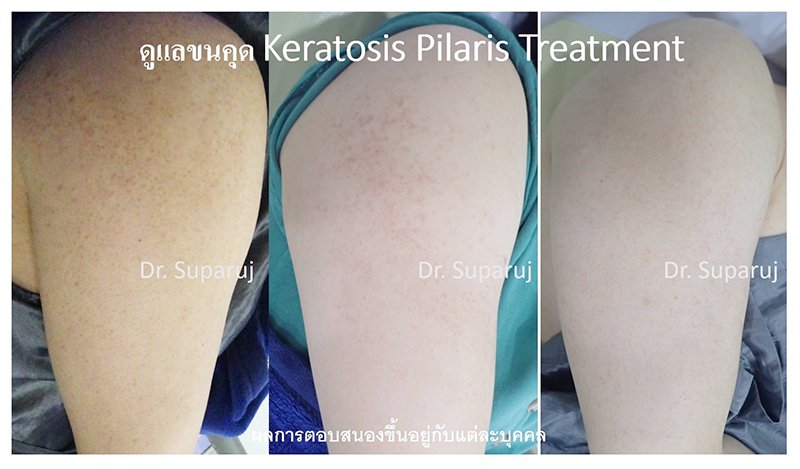 คำแนะนำในการดูแลผิวสำหรับผู้ที่มีปัญหาขนคุด KP Keratosis Pilaris คำแนะนำในการดูแลผิวสำหรับผู้ที่มีปัญหาขนคุด KP Keratosis Pilaris