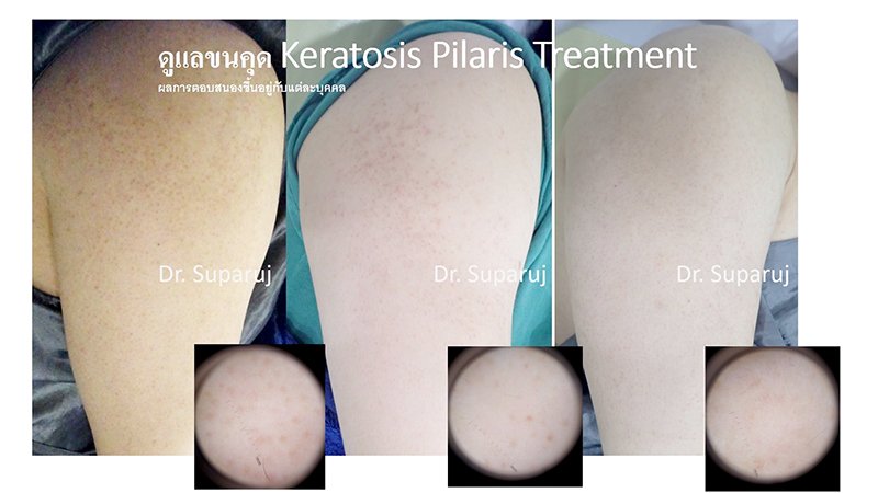 คำแนะนำในการดูแลผิวสำหรับผู้ที่มีปัญหาขนคุด KP Keratosis Pilaris