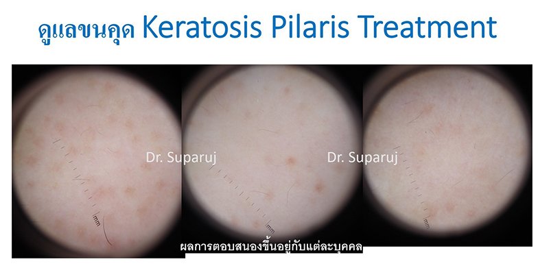 คำแนะนำในการดูแลผิวสำหรับผู้ที่มีปัญหาขนคุด KP Keratosis Pilaris คำแนะนำในการดูแลผิวสำหรับผู้ที่มีปัญหาขนคุด KP Keratosis Pilaris