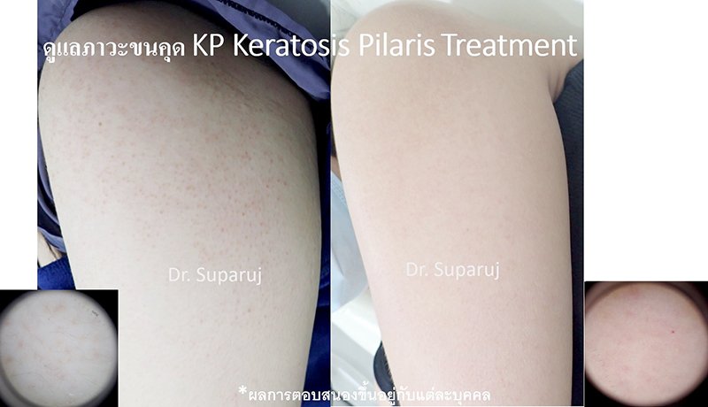 คำแนะนำในการดูแลผิวสำหรับผู้ที่มีปัญหาขนคุด KP Keratosis Pilaris คำแนะนำในการดูแลผิวสำหรับผู้ที่มีปัญหาขนคุด KP Keratosis Pilaris
