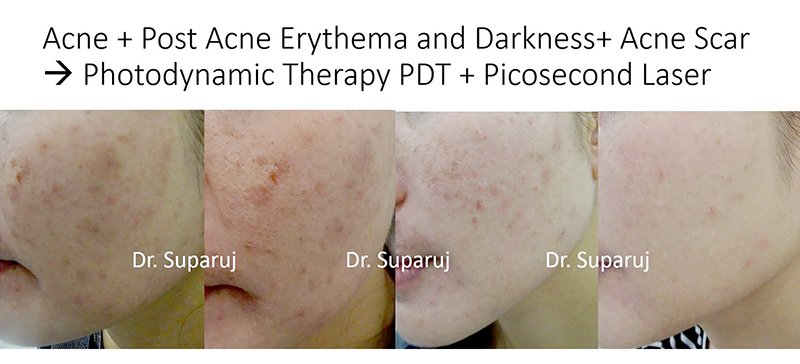 การรักษาสิวด้วย Photodynamic therapy (PDT) คืออะไร? การรักษาสิวด้วย Photodynamic therapy (PDT) คืออะไร?