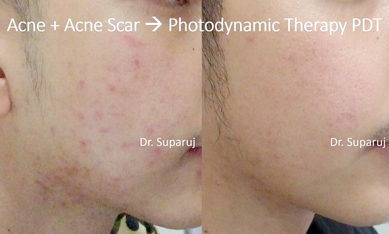 การรักษาสิวด้วย Photodynamic therapy (PDT) คืออะไร? การรักษาสิวด้วย Photodynamic therapy (PDT) คืออะไร?