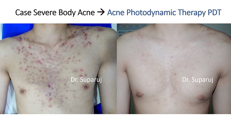 การรักษาสิวด้วย Photodynamic therapy (PDT) คืออะไร? การรักษาสิวด้วย Photodynamic therapy (PDT) คืออะไร?