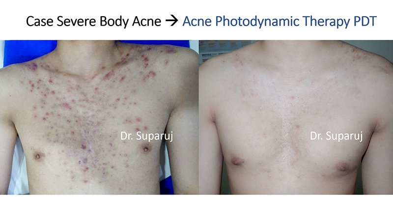 การรักษาสิวด้วย Photodynamic therapy (PDT) คืออะไร?