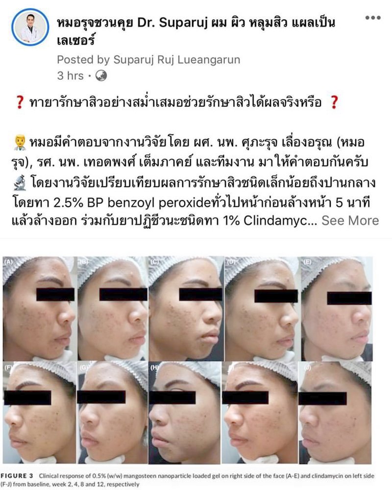 ทายารักษาสิวอย่างสม่ำเสมอช่วยรักษาสิวได้ผลจริงหรือ ?