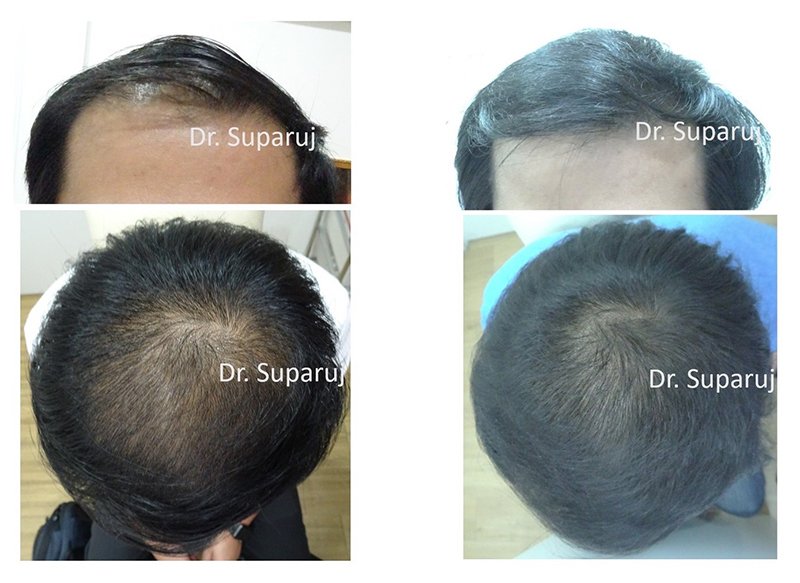 เลเซอร์ Low Level Laser Therapy LLLT ดูแลผมร่วงผมบาง เลเซอร์ Low Level Laser Therapy LLLT ดูแลผมร่วงผมบาง