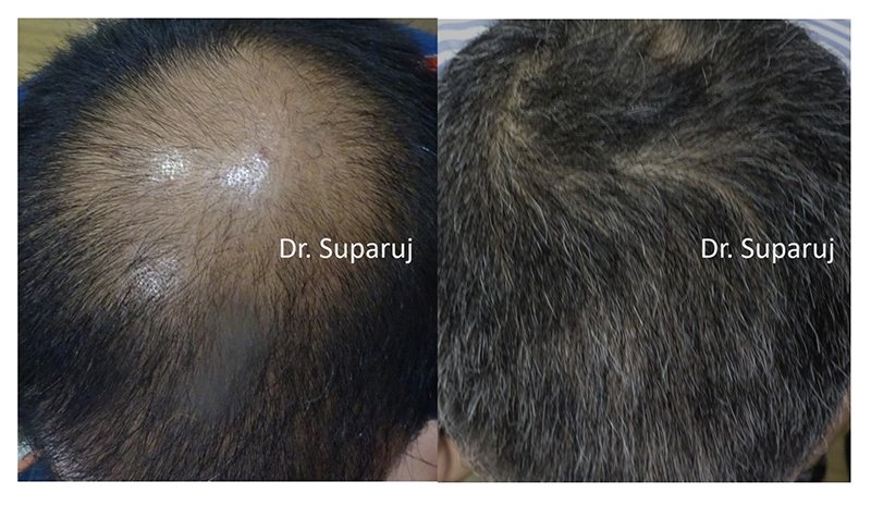 เลเซอร์ Low Level Laser Therapy LLLT ดูแลผมร่วงผมบาง เลเซอร์ Low Level Laser Therapy LLLT ดูแลผมร่วงผมบาง