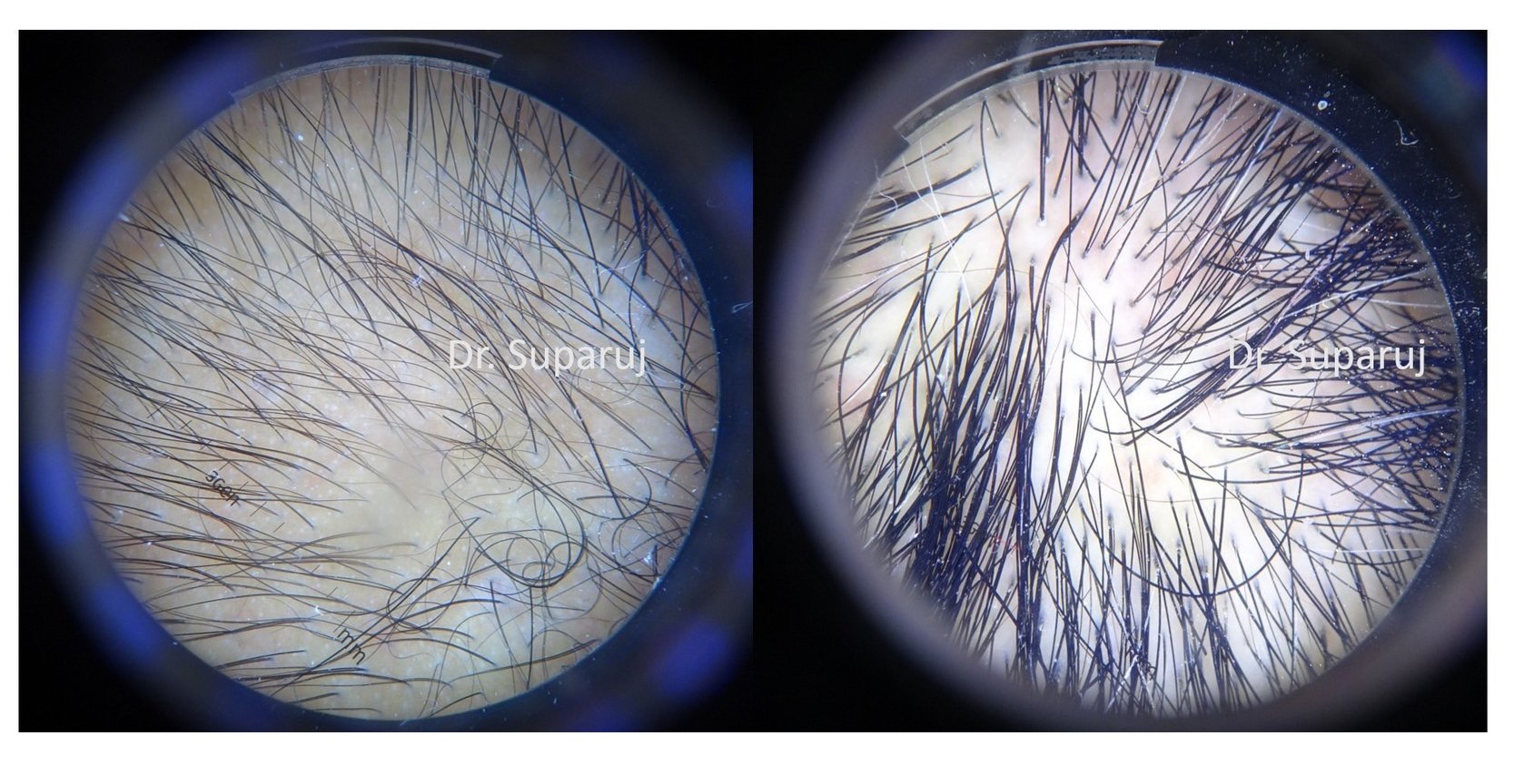 เลเซอร์ Low Level Laser Therapy LLLT ดูแลผมร่วงผมบาง เลเซอร์ Low Level Laser Therapy LLLT ดูแลผมร่วงผมบาง