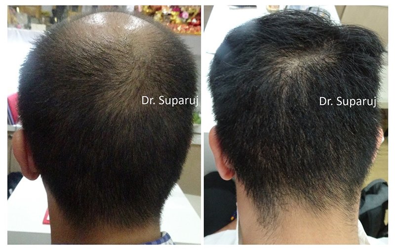 เลเซอร์ Low Level Laser Therapy LLLT ดูแลผมร่วงผมบาง เลเซอร์ Low Level Laser Therapy LLLT ดูแลผมร่วงผมบาง