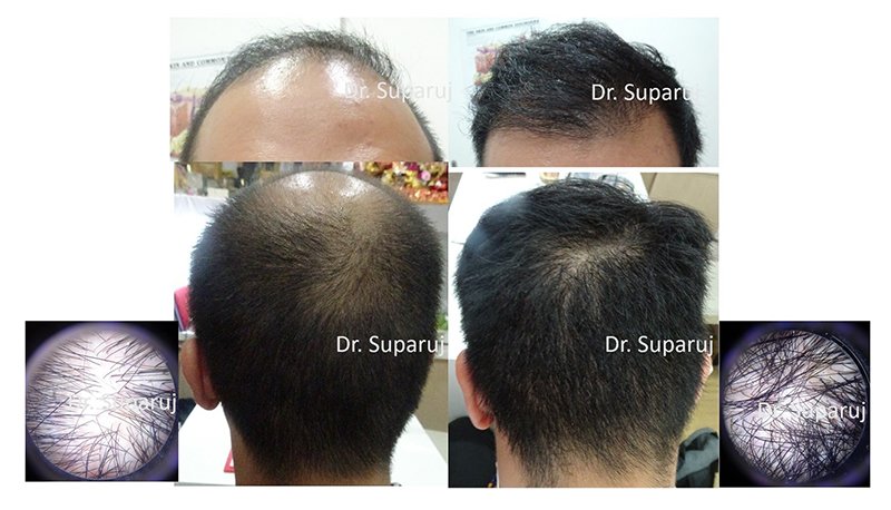 เลเซอร์ Low Level Laser Therapy LLLT ดูแลผมร่วงผมบาง เลเซอร์ Low Level Laser Therapy LLLT ดูแลผมร่วงผมบาง