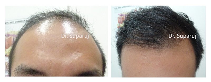 เลเซอร์ Low Level Laser Therapy LLLT ดูแลผมร่วงผมบาง เลเซอร์ Low Level Laser Therapy LLLT ดูแลผมร่วงผมบาง