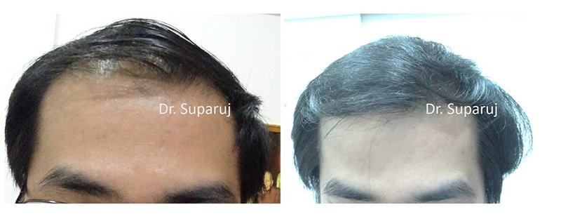 เลเซอร์ Low Level Laser Therapy LLLT ดูแลผมร่วงผมบาง เลเซอร์ Low Level Laser Therapy LLLT ดูแลผมร่วงผมบาง