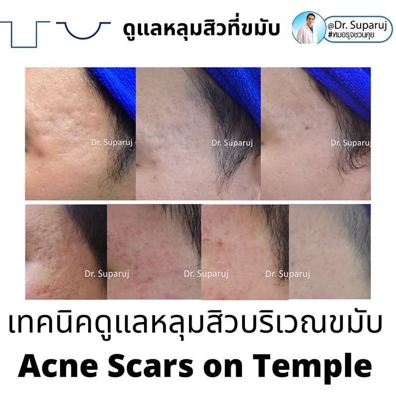 เทคนิคดูแลหลุมสิวบริเวณขมับ !! เทคนิคดูแลหลุมสิวบริเวณขมับ !!