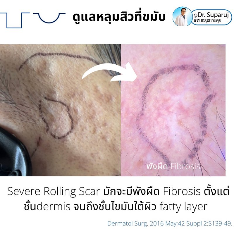 เทคนิคดูแลหลุมสิวบริเวณขมับ !! เทคนิคดูแลหลุมสิวบริเวณขมับ !!