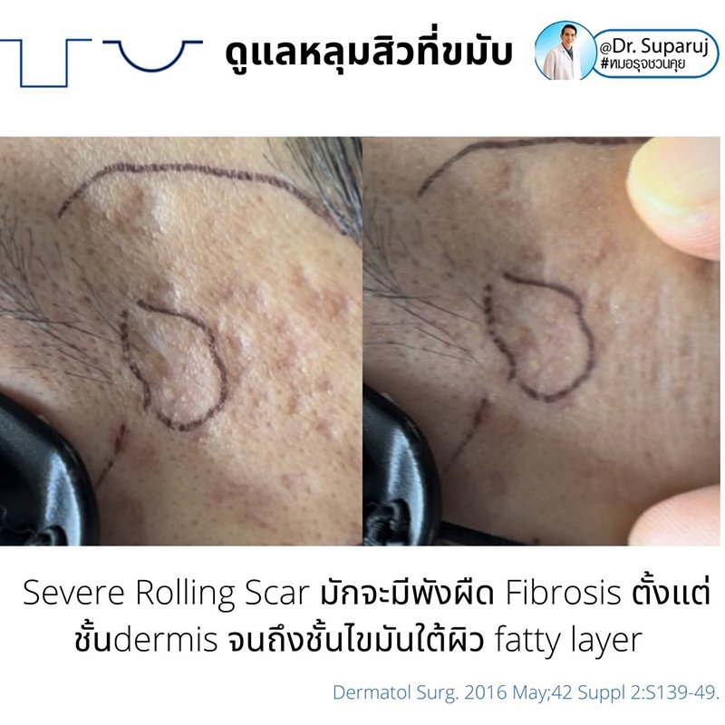 เทคนิคดูแลหลุมสิวบริเวณขมับ !! เทคนิคดูแลหลุมสิวบริเวณขมับ !!