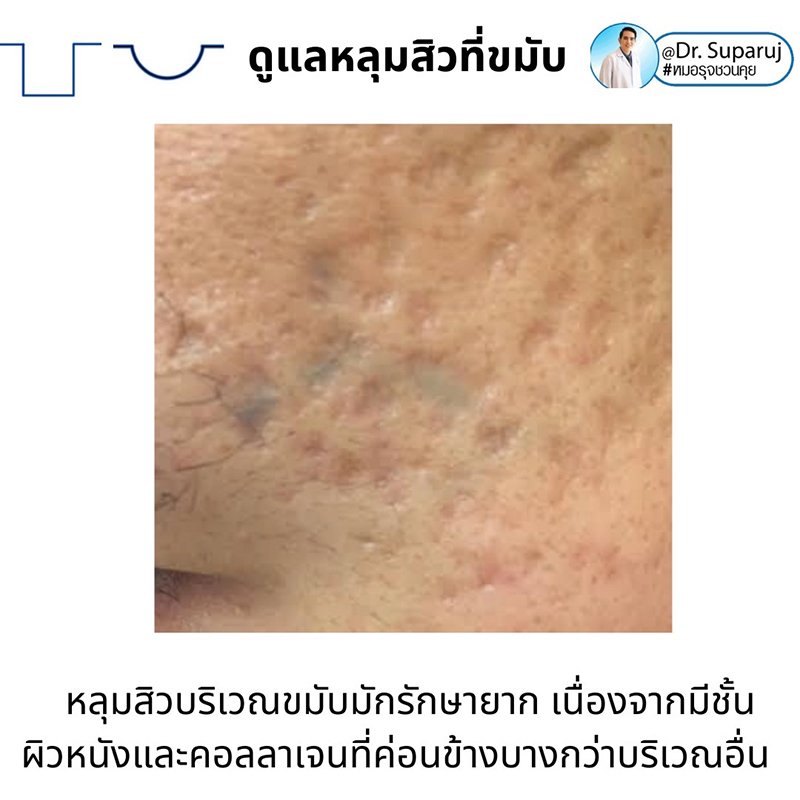 เทคนิคดูแลหลุมสิวบริเวณขมับ !! เทคนิคดูแลหลุมสิวบริเวณขมับ !!