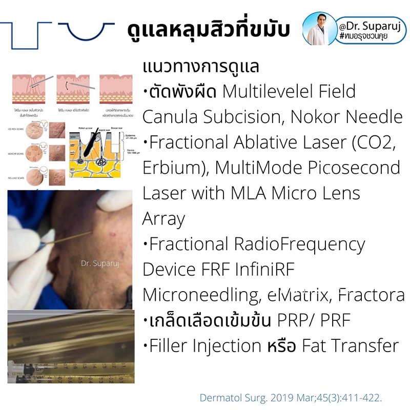 เทคนิคดูแลหลุมสิวบริเวณขมับ !! เทคนิคดูแลหลุมสิวบริเวณขมับ !!