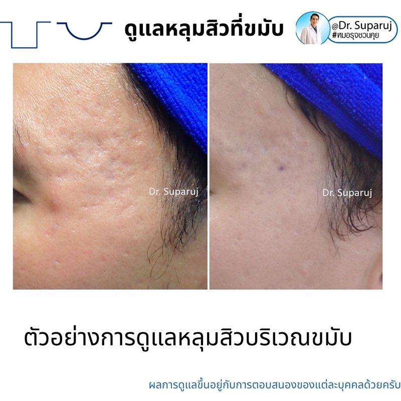 เทคนิคดูแลหลุมสิวบริเวณขมับ !! เทคนิคดูแลหลุมสิวบริเวณขมับ !!