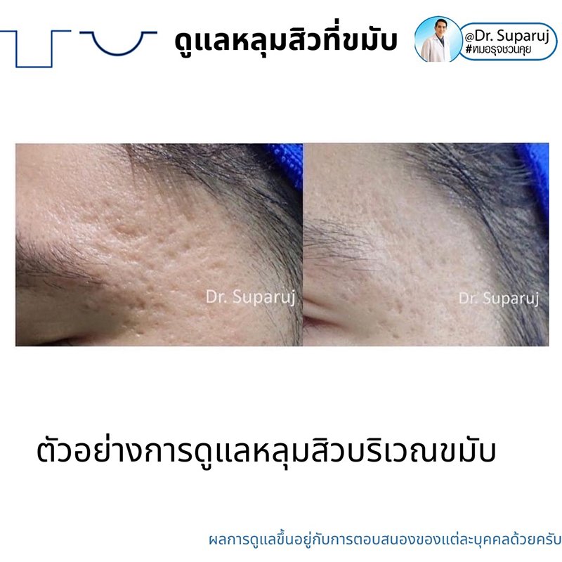 เทคนิคดูแลหลุมสิวบริเวณขมับ !! เทคนิคดูแลหลุมสิวบริเวณขมับ !!