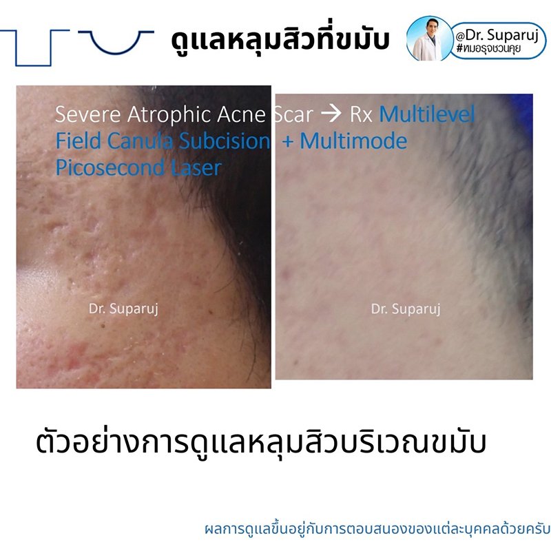 เทคนิคดูแลหลุมสิวบริเวณขมับ !! เทคนิคดูแลหลุมสิวบริเวณขมับ !!