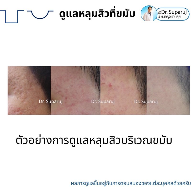 เทคนิคดูแลหลุมสิวบริเวณขมับ !! เทคนิคดูแลหลุมสิวบริเวณขมับ !!