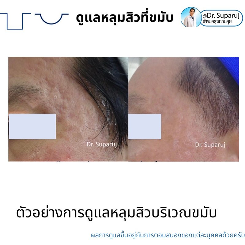 เทคนิคดูแลหลุมสิวบริเวณขมับ !! เทคนิคดูแลหลุมสิวบริเวณขมับ !!