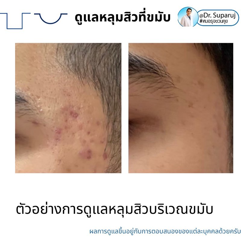 เทคนิคดูแลหลุมสิวบริเวณขมับ !! เทคนิคดูแลหลุมสิวบริเวณขมับ !!