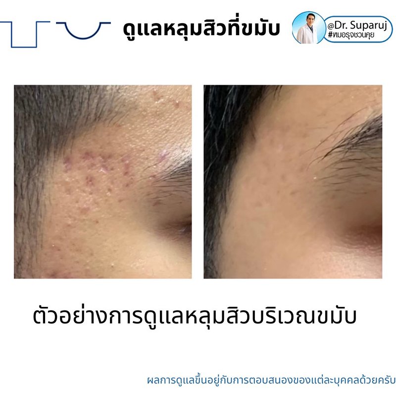 เทคนิคดูแลหลุมสิวบริเวณขมับ !! เทคนิคดูแลหลุมสิวบริเวณขมับ !!