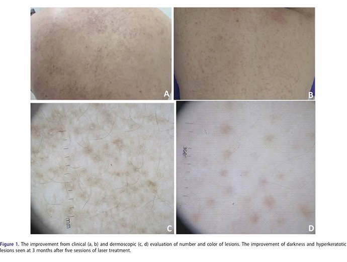 ผื่น lichen amyloidosus (หรือ amyloidosis) มีลักษณะอย่างไร ดูแลได้อย่างไร ผื่น lichen amyloidosus (หรือ amyloidosis) มีลักษณะอย่างไร ดูแลได้อย่างไร